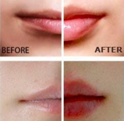 Instant Fuller Lips – Electric Lip Plumper Device